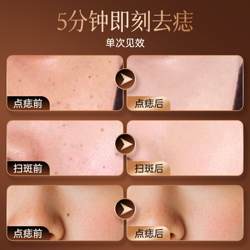 russian hot-selling electric mole spot pen, small white spot removal, laser spot removal, metal body beauty pen