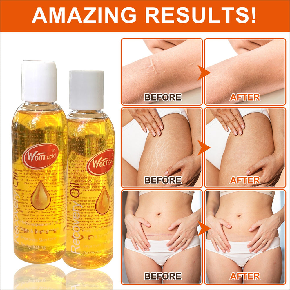 stretch mark oil - melanin reducing, dark spot correcting, multivitamin massage oil 100ml - repair oil for export